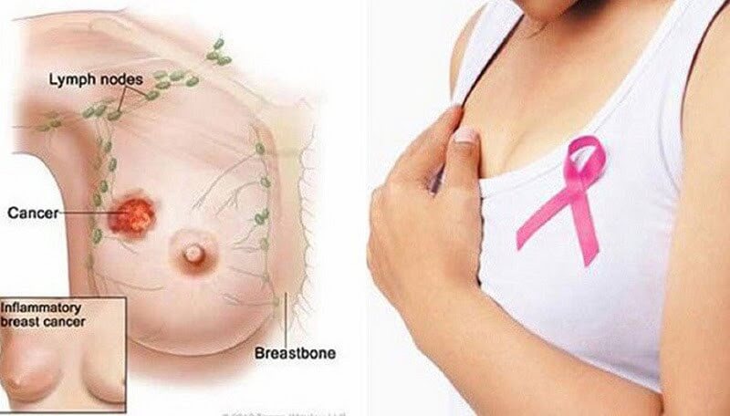 Tìm hiểu ung thư vú là gì?